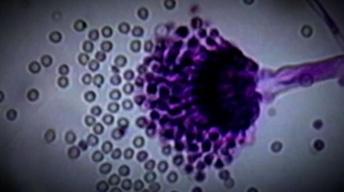 Tainted Steroid Drugs Caused Deadly Meningitis Outbreak