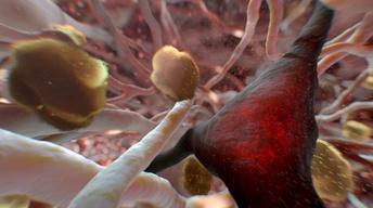 S43 Ep8: Can Alzheimer's Be Stopped? Preview