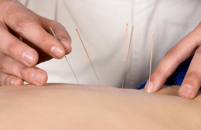 How Acupuncture Can Reduce the Need for Medications