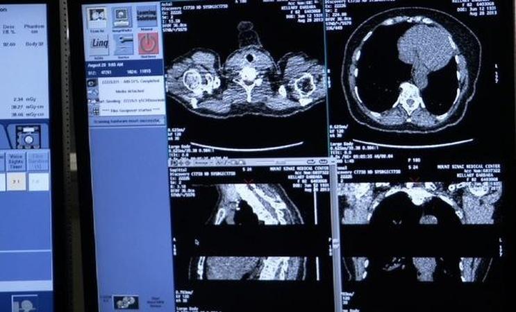 Can CT scans for smokers save lives?