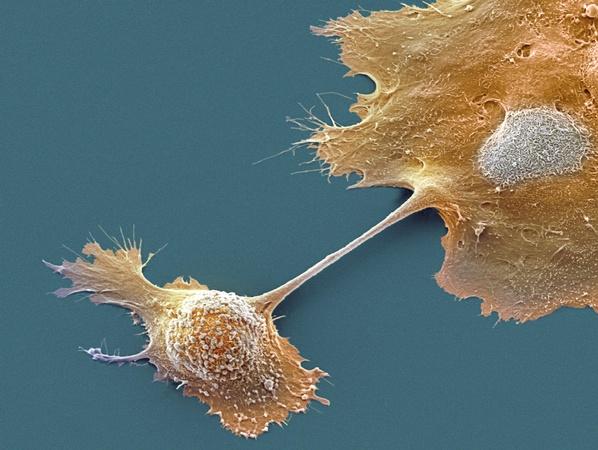 Luck, not lifestyle, may be to blame for some cancers
