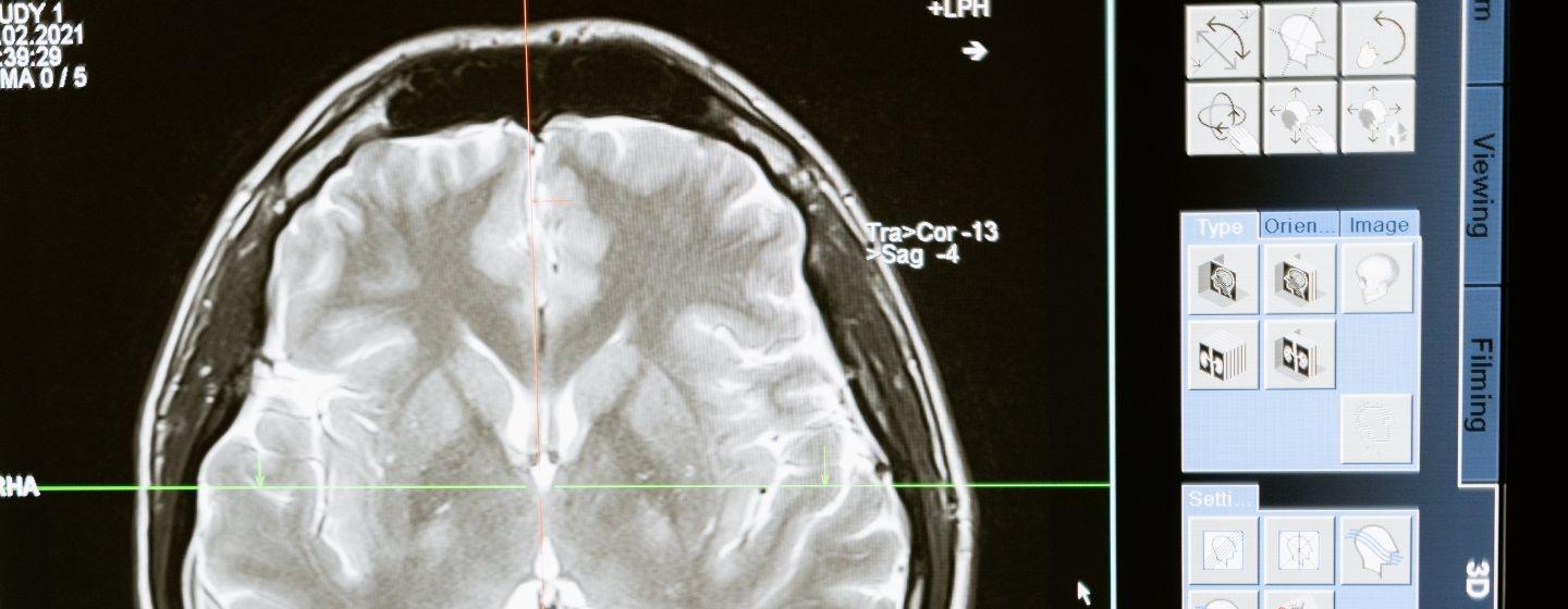 A digital image of a brain scan.