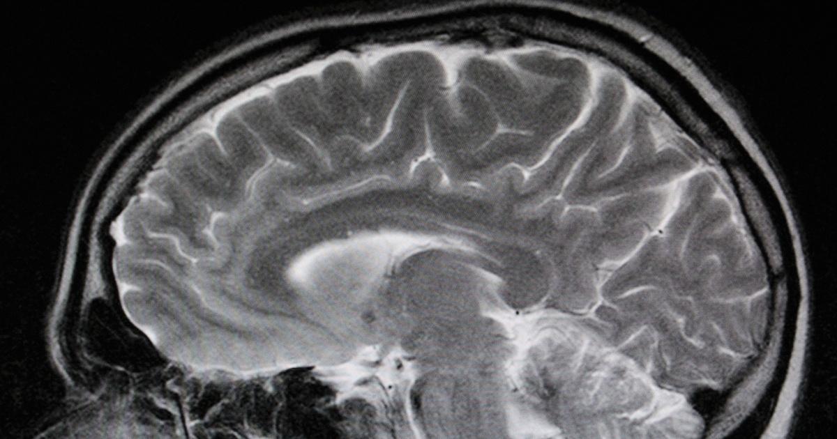 Concussion: Answers in the Blood? PBS