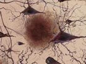 Slowing Alzheimer's Progress