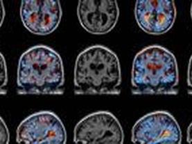 A Viral Alzheimer's Cure?