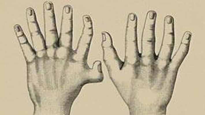 polydactyly essay Having an extra finger or toe is called polydactyly the extra digit may range from a small, raised bump to a complete, working finger or toe. polydactyly essay Having an extra finger or toe is called polydactyly the extra digit may range from a small, raised bump to a complete, working finger or toe.
