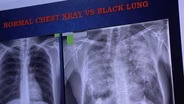 Black Lung Rises to Highest Level in Nearly 50 Years