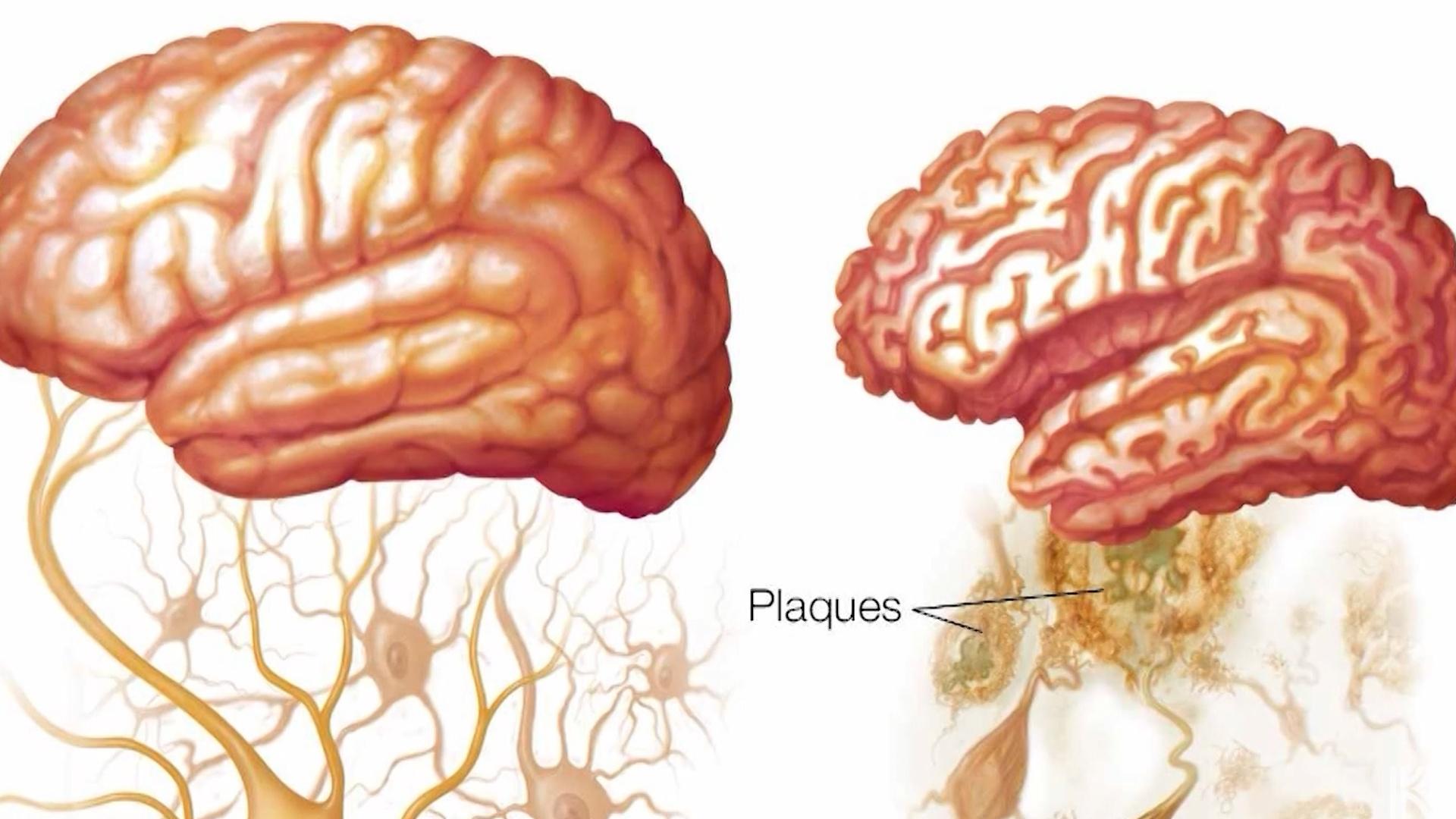 Alzheimer's Advancements and Impact on Kentuckians