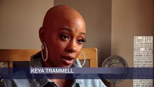 She Was Bullied for Alopecia. Now She is Bald and Proud.