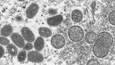 First probable case of monkeypox identified in NJ