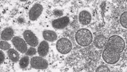 First probable case of monkeypox identified in NJ