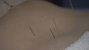Acupuncture & Medicaid; Foster Families Needed