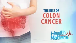 The Rise of Colon Cancer