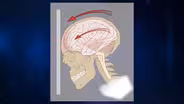 Genetic markers for concussions