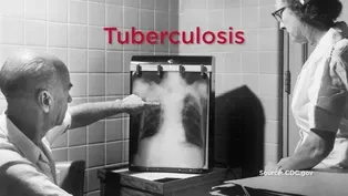 Tuberculosis