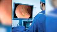 New technology can detect pre-cancerous polyps