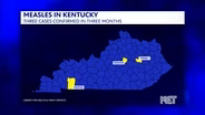 Confirmed Case of Measles in Jessamine County Resident