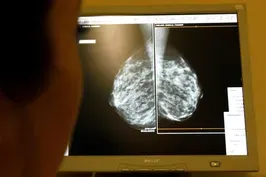 New guidelines recommend mammograms start at 40