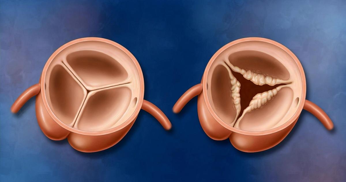 Side Effect Of Transcatheter Aortic Valve Replacement