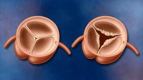 Video thumbnail: The Latest Procedure Transcatheter Aortic Valve Replacement