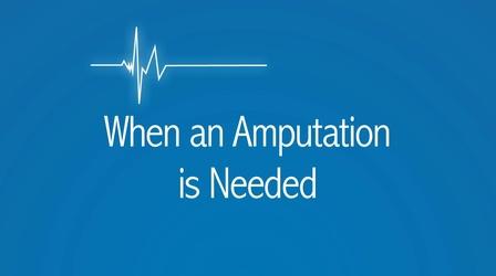 Video thumbnail: The Latest Procedure When an Amputation is Needed