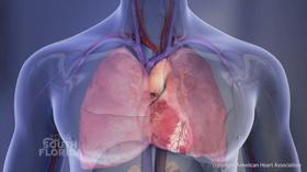 Video thumbnail: Your South Florida American Heart Month