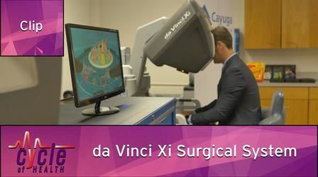 Video thumbnail: Cycle of Health Cayuga Medical Center: da Vinci Xi Surgical System