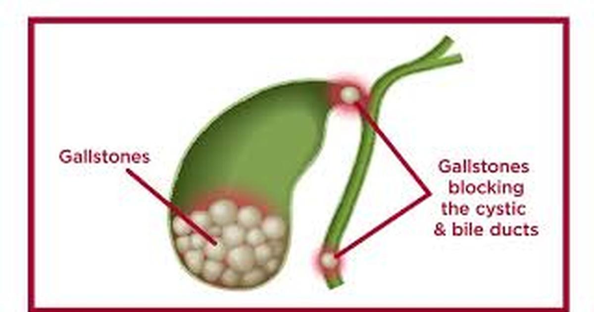 Line One: Your Health Connection | Gallstones | PBS