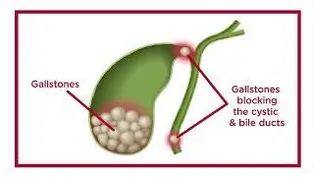 Gallstones