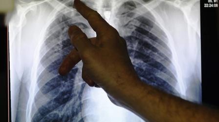 Video thumbnail: PBS NewsHour New drugs may stop TB, world's top infectious killer