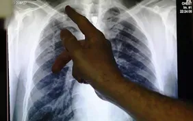 New drugs may stop TB, world's top infectious killer