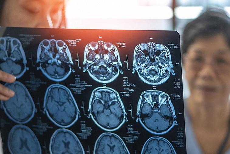 Genetic mutation could unlock new ways to treat dementia Poster