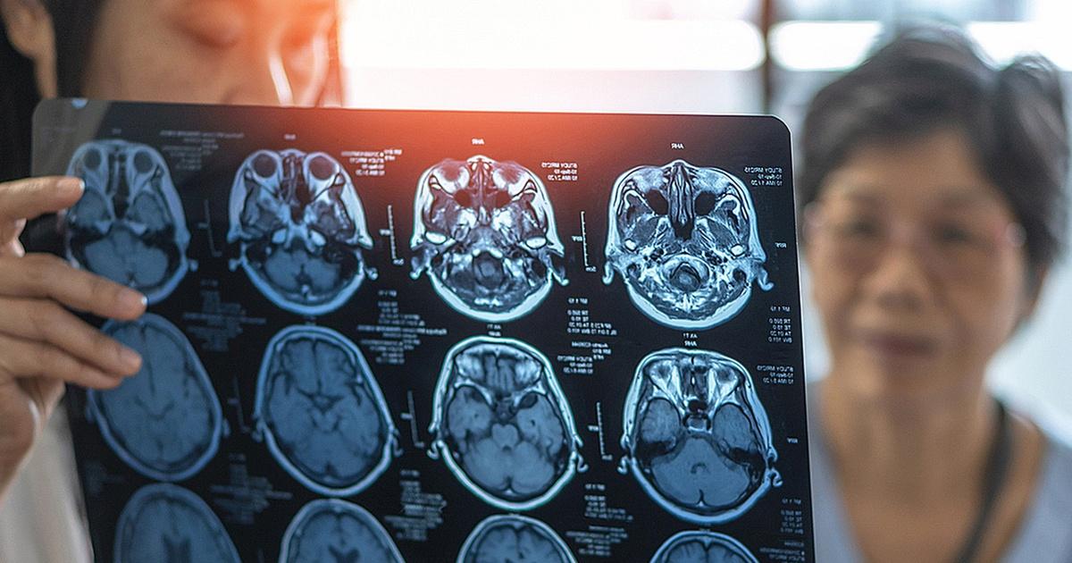 Genetic mutation could unlock new ways to treat dementia - PBS