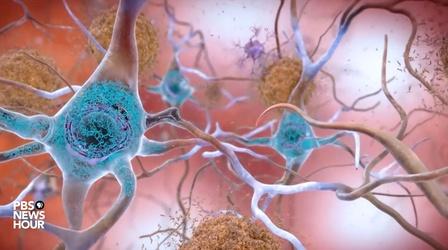 Video thumbnail: PBS NewsHour Can ultrasound be used to fight Alzheimer's?