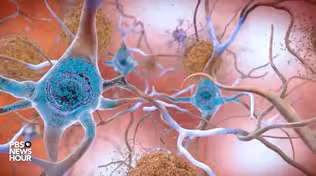Can ultrasound be used to fight Alzheimer's?