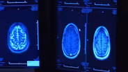 Living with Multiple Sclerosis & Myasthenia Gravis - Preview