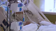 1 in 3 patients has long-term health problems from COVID-19