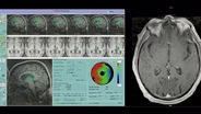 Beyond the Flavor/UVa MRI-guided Focused Ultrasound Program
