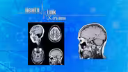 Xtra Dose | Parkinson's Disease