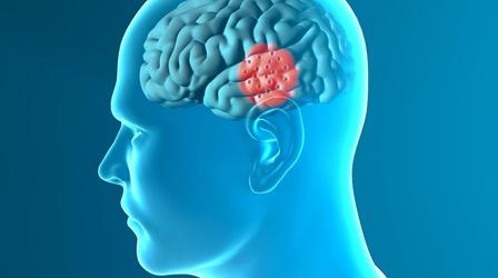 Video thumbnail: Health Link Latest in the Treatment of Parkinson’s Disease