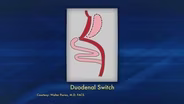 Duodenal Switch Explained