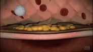 NC Now Special: Heart Disease