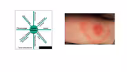 Lyme Disease
