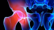 When is the Right Time for Joint Replacement?