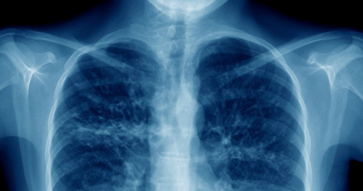 NOVA | The Battle to Breathe | Season 53 | Episode 9 - PBS
