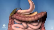 Preparing for Weight Loss Surgery