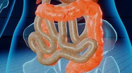Video thumbnail: Call The Doctor What to Know About Esophageal Cancer - Preview