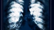 Kentucky Ranks First in Nation for New Lung Cancer Cases