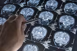 Why migraine disease involves more than just a headache