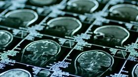 Video thumbnail: Virginia Currents Concussions in Women Athletes | Pocahontas Festival